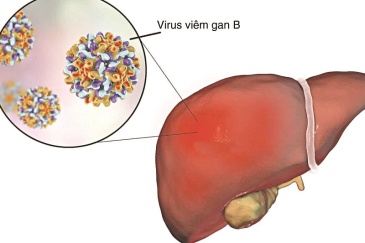 Viêm gan B: Nhận biết và điều trị hiệu quả